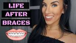 WHAT TO EXPECT WHEN YOUR BRACES COME OFF! Chels Nichole - Yo