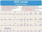 ECG : normal : e-cardiogram