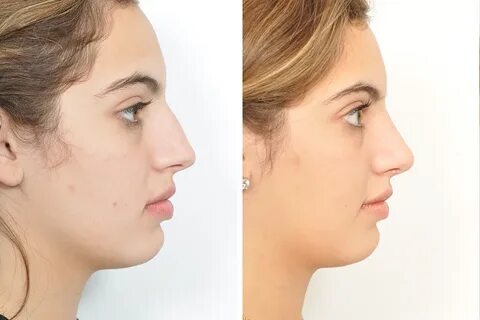 Top Celebrity Rhinoplasty Surgeon, Natural Looking Nose Job 