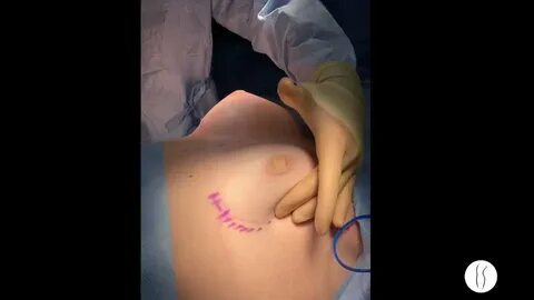 Breast Augmentation with Silicone Implants - Video - RealSel