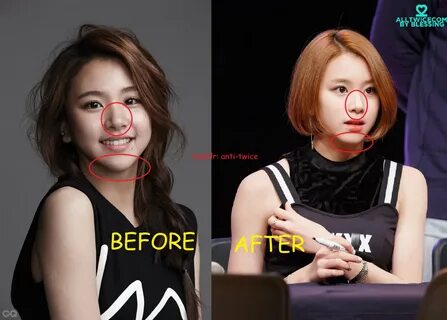 Twice Plastic Surgery Quora - The Moment Style