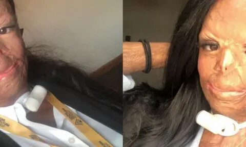 Pakai Sampo Anti Kutu, Rambut Remaja Ini Terbakar dan Koma 2