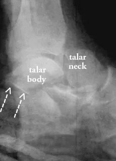 Talar Neck Fracture Related Keywords & Suggestions - Talar N