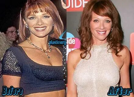 Lauren Holly Plastic Surgery Before After Photos - Plastic S