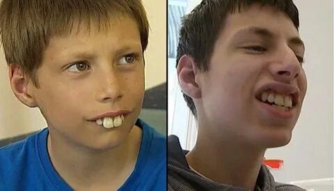 After Years Of Being Bullied For His Teeth, This Boy Is Fina