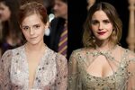 Emma Watson Cosmetic Surgery - Nose Job, Teeth & Breast Impl