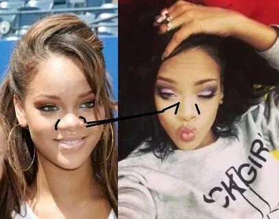 Rihanna Before and After the Nose Job Procedure Cirurgias