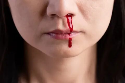 Premium Photo Nosebleed, woman with a bloody nose. healthcar