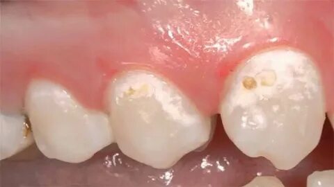 Weiße Flecken auf den Zähnen eines Kindes, warum erscheinen 