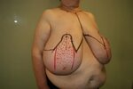 Gigantomastia (Macromastia) y Cáncer de Mama - Breast Surgeo