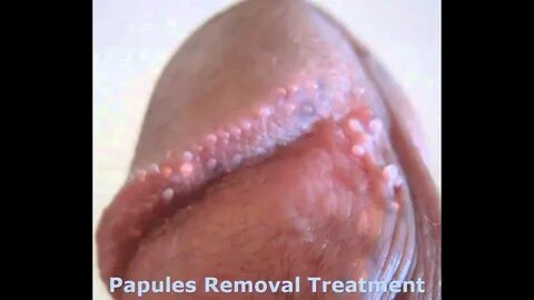 Pearly Penile Papules Wiki Further Reading - YouTube