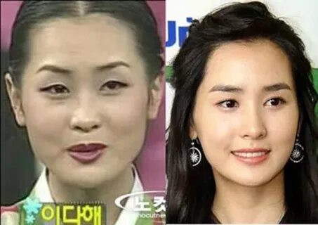 Li Kim Before After Surgery Popular