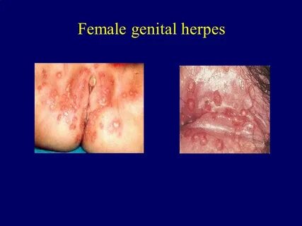 Genital Herpes & Genital Warts By Dr. Mona Badr & Dr. Abdulk