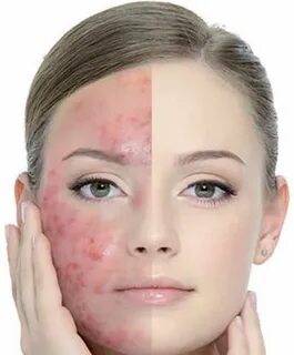 Acne - How to Reduce Acne at Home?? Natural acne remedies, A