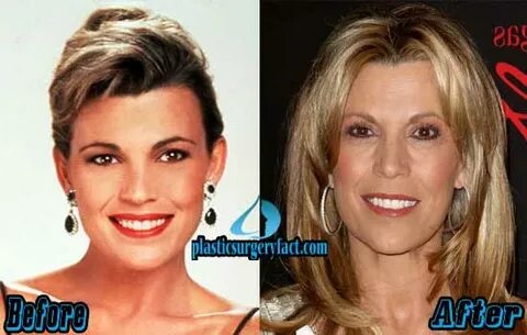 Vanna White Plastic Surgery - Plastic Industry In The World