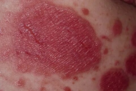 Psoriasis: 10 Causes, Treatment, Symptoms, Types & Pictures