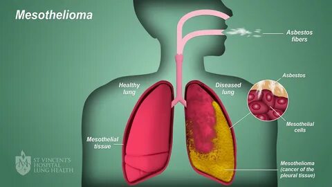 Mesothelioma - St Vincent's Lung Health