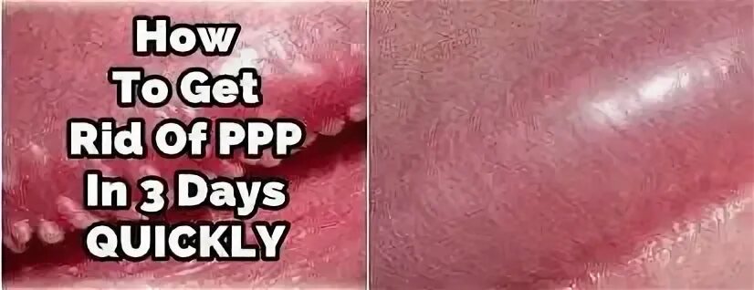 How To Get Rid Of Pearly Penile Papules (bumps) In 3 Days