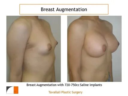 Breast_Augmentation_18 Tavallali Plastic Surgery