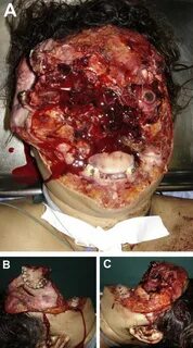 An impressive case of complete traumatic maxillofacial deglo
