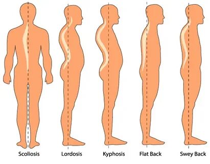 Lumbar Lordosis Causes and Treatments Orthopedic Blog