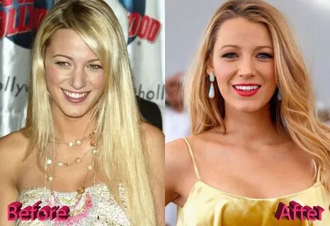 Blake Lively Nose Job: Looking Better Then Ever