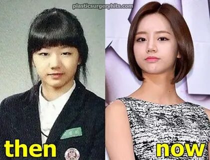 Lee Hyeri Plastic Surgery Before and After - Plastic Surgery