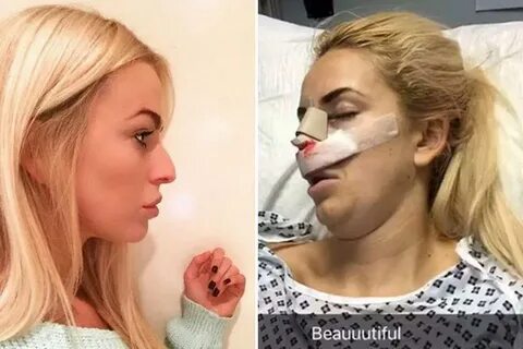 Newcastle lass goes under the knife in the first nose job st