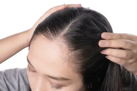 Hairline asian woman