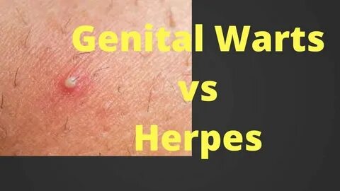 Genital Warts Vs Herpes - Herpes Vs Genital Warts - Differen