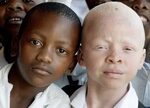 Tanzania, bimbo albino mutilato e ucciso per magia nera - Af