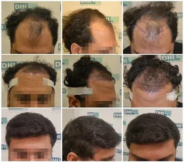 Hair Transplant Near Me