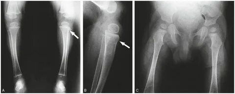 Differential diagnosis III: osteogenesis imperfecta Radiolog