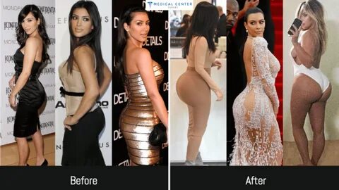 Are kim kardashian's boobs and butt fake