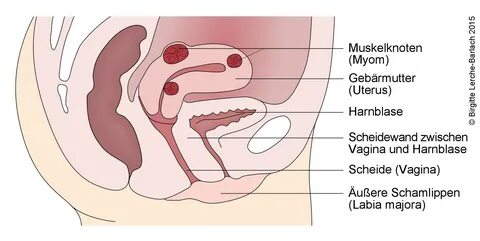 Gebärmuttermyome (Muskelknoten der Gebärmutter) - DEXIMED - 