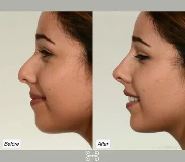 How Much Does It Cost To Get A Nose Job In South Africa " Ne