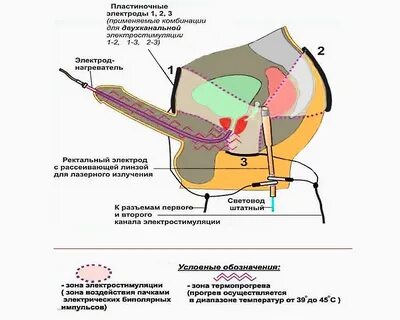 Что такое электростимуляция предстательной железы? Электрост