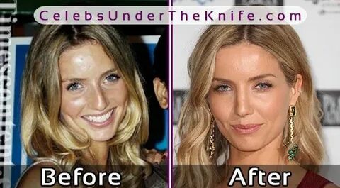 PEAKY BLINDERS - Annabelle Wallis Nose Job Photos #celebsund