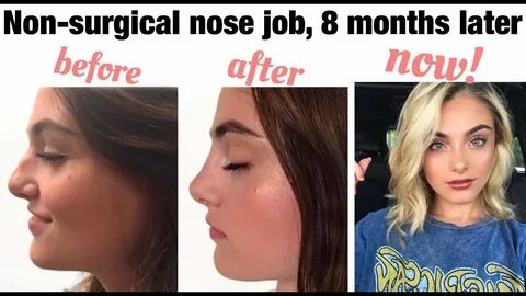 Non-Surgical Nose Job 8 Months Later + Permanent Filler Befo