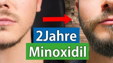 2 Jahre Minoxidil für den Bart Das Minoxidil Experiment Woch