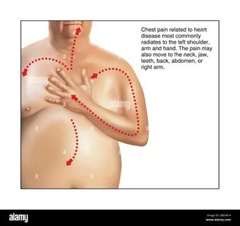 angina, annotated, artery, chest pain, coronary artery disease, disease, fa...