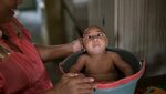 CDC: Evidence definitively shows Zika causes birth defects F