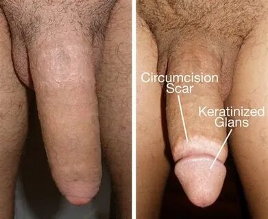 Circumcised Vs Uncircumcised Vagina Datawav Free Download Nu