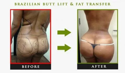 Brazilian Butt Lift/Fat Transfer of March 26, 2016