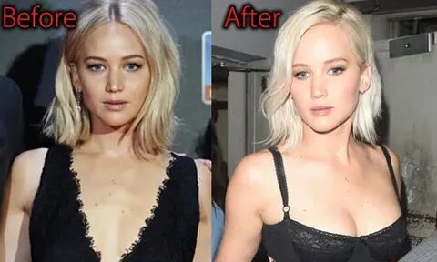 Jennifer Lawrence Plastic Surgery, Before and After Nose Job
