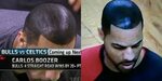 Hair Transplant Sherdog Forums UFC, MMA & Boxing Discussion