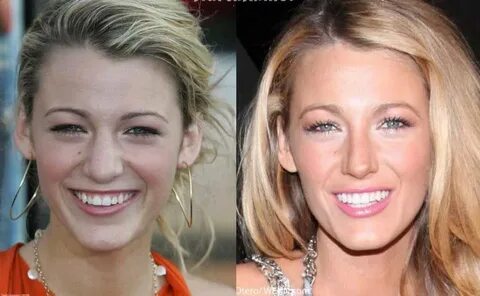 Blake Lively-before and after extensive dental work & a nose