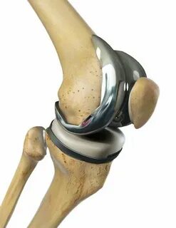 Полное эндопротезирование Knee replacement ortoped-klinik.co
