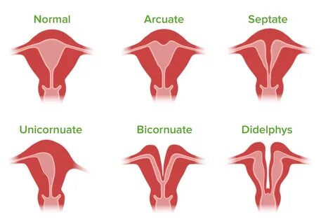 Congenital Malformations of the Female Reproductive System C