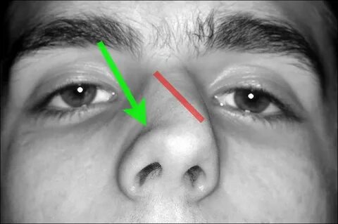 Rhinoplasty tutorial, Nasal septum: page 7, Enlarged - Facia